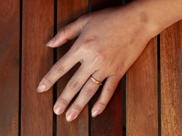 Zo herken en behandel je een pijnlijke vinger door fijt